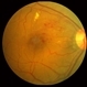 BRVO with Hemorrhages and Lipid BRVO with Hemorrhages and Lipid